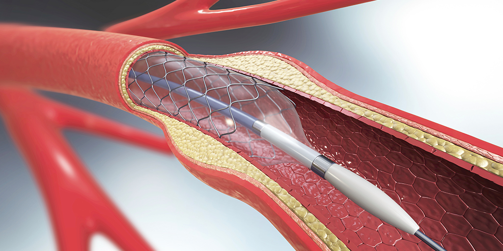 P-C-MKT95209-New_Stent_Study_1024x512 Illustration