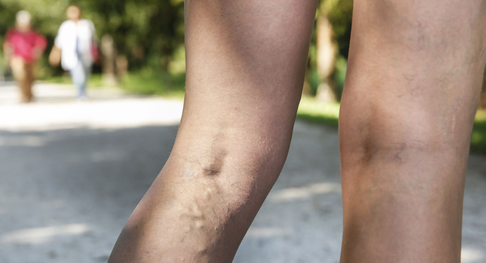 p-w-wmn53040-varicose-veins-lg