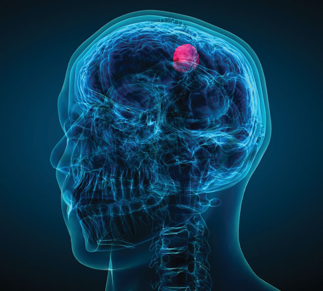 Simple Headache or Brain Tumor? Check These Symptoms - In Content