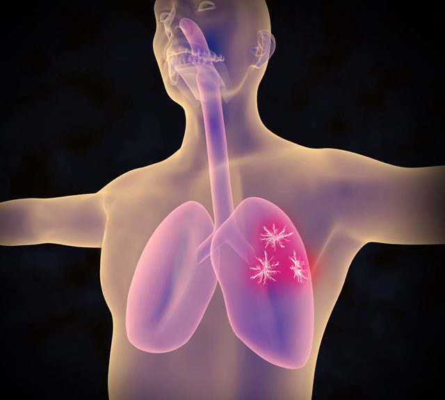 When Cancer Spreads to the Lungs What to Know - In Content