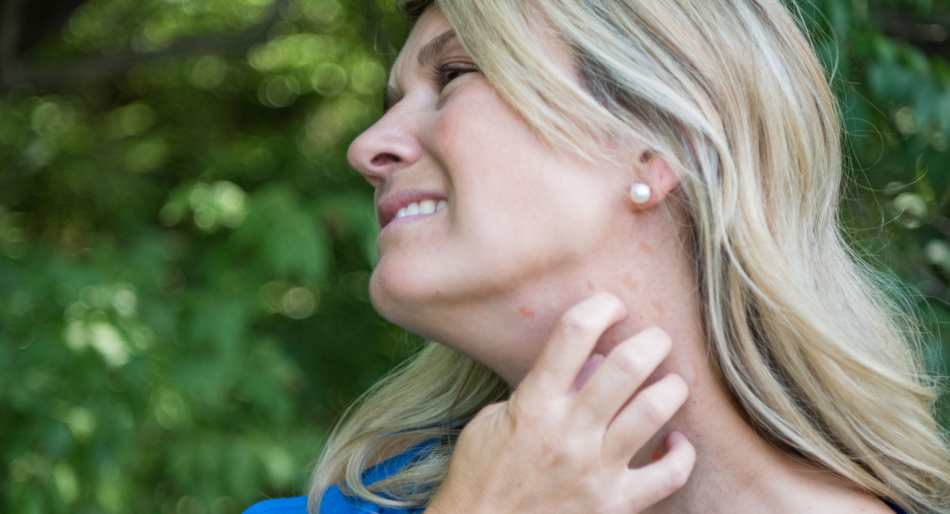 p-w-wmn71447-coping-with-hives-lg