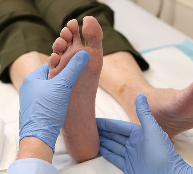 Nailing a Treatment for Hammer Toe 