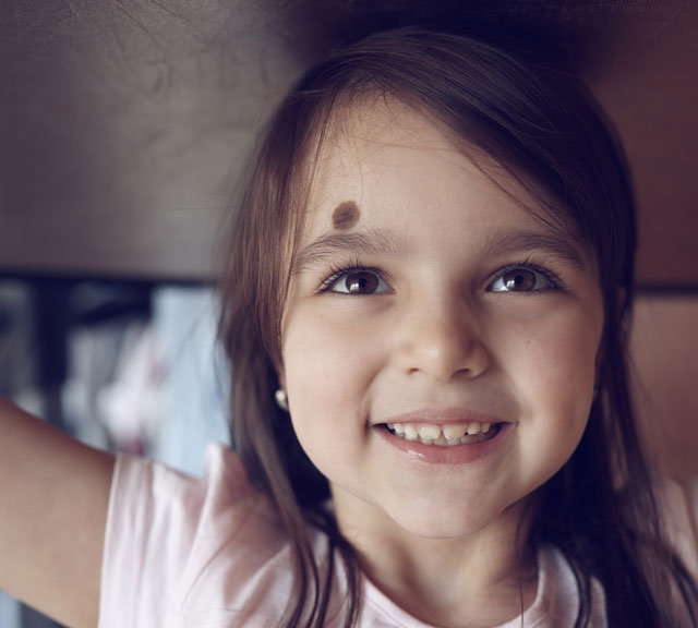 Hemangioma Birthmark small Hemangioma Birthmark small