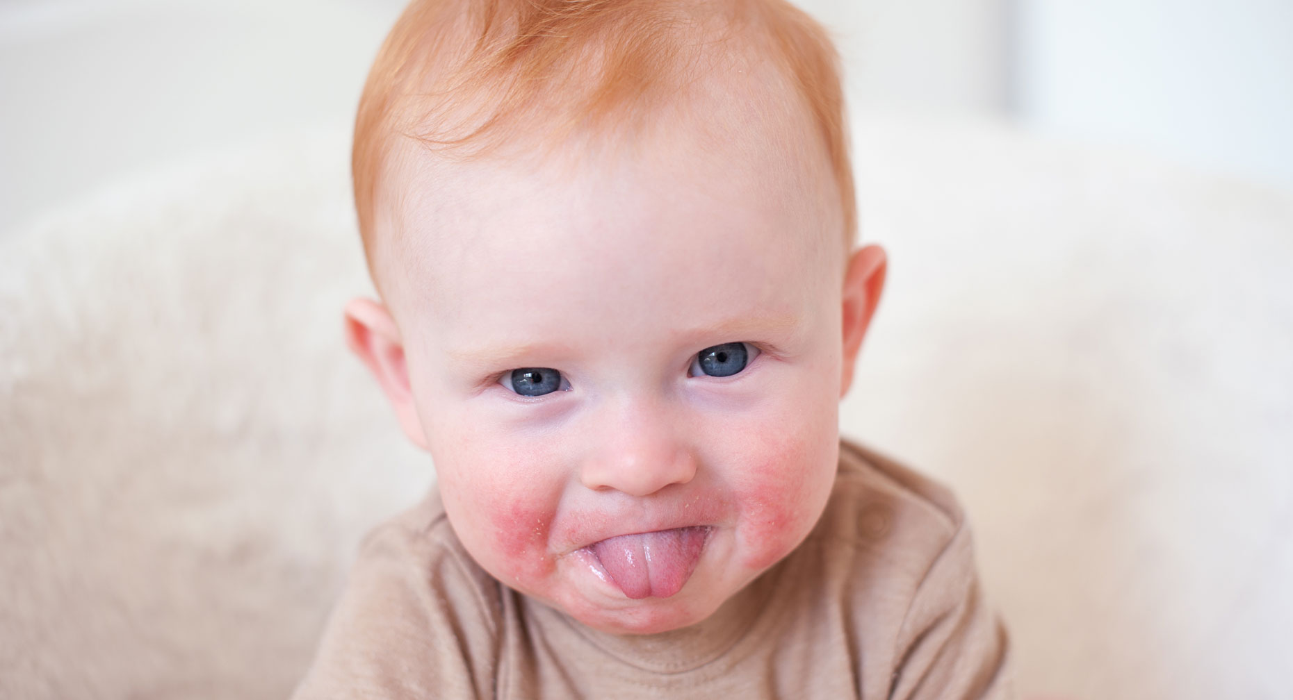 Red Rash Fifth Disease large Red Rash Fifth Disease large
